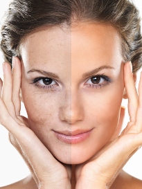 Facial-BeforeAfter-Reduced40Percent